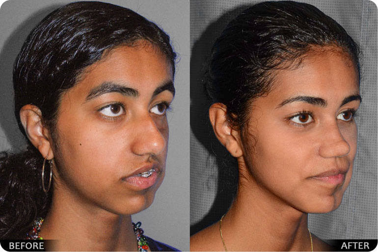 Orthognathic before and after Image 01