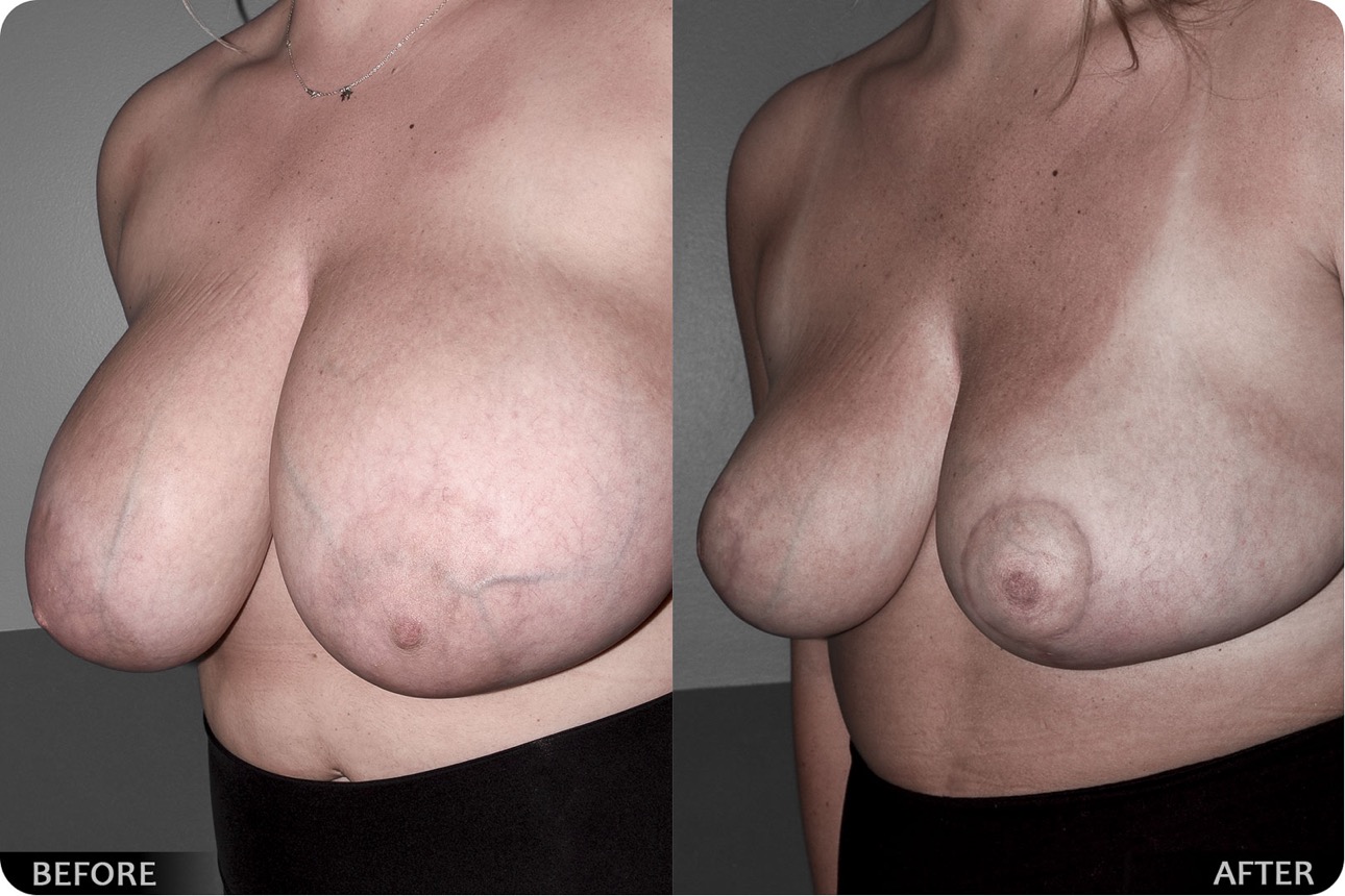 Breast implant - photo 02