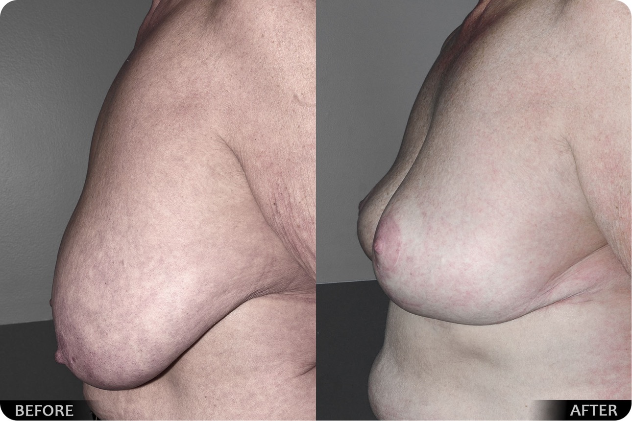Breast implant - photo 04