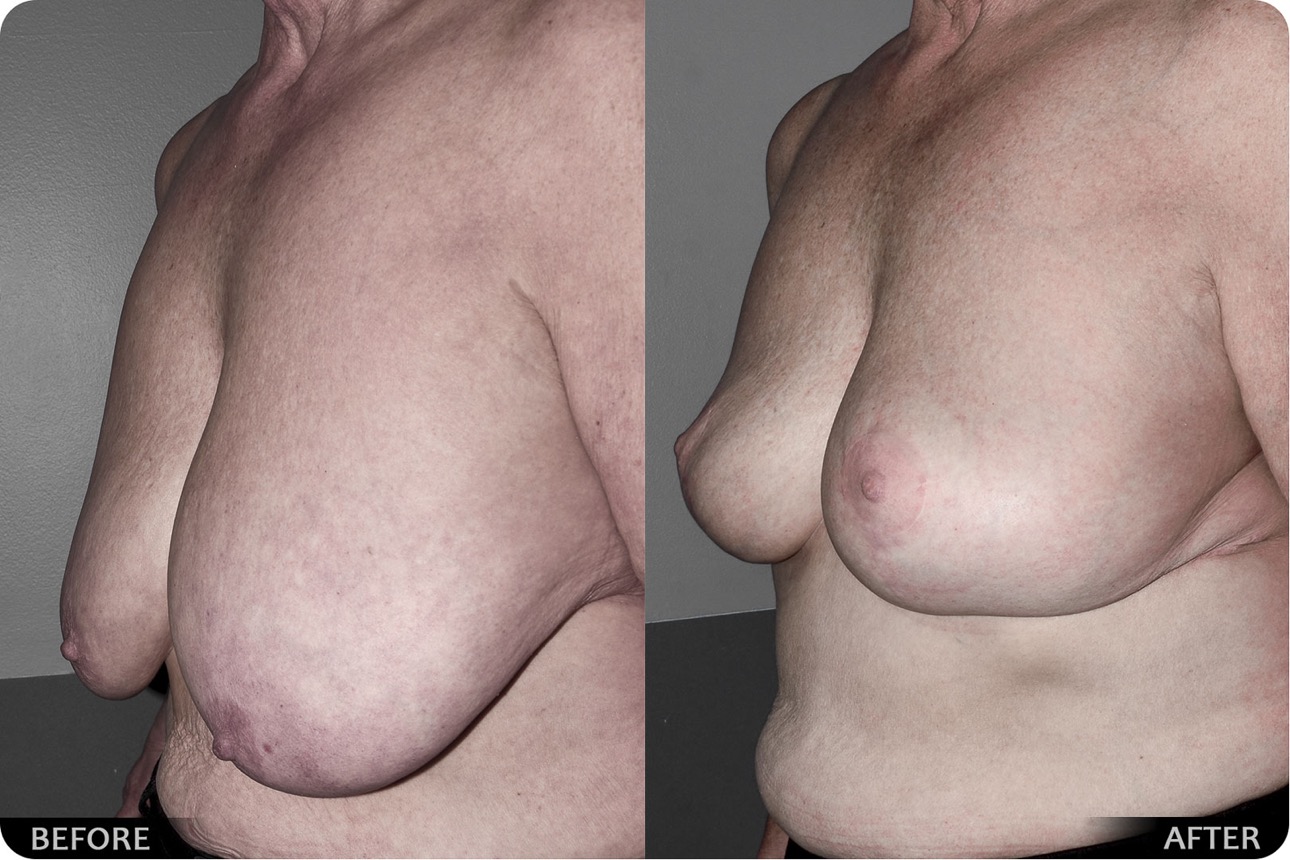 Breast implant - photo 01