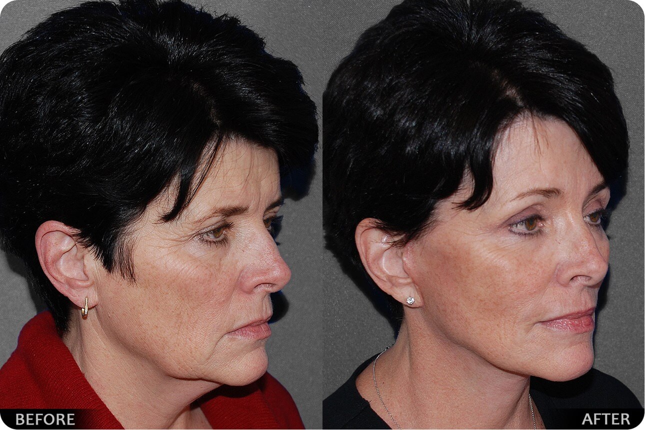 Face lift before and after - 10