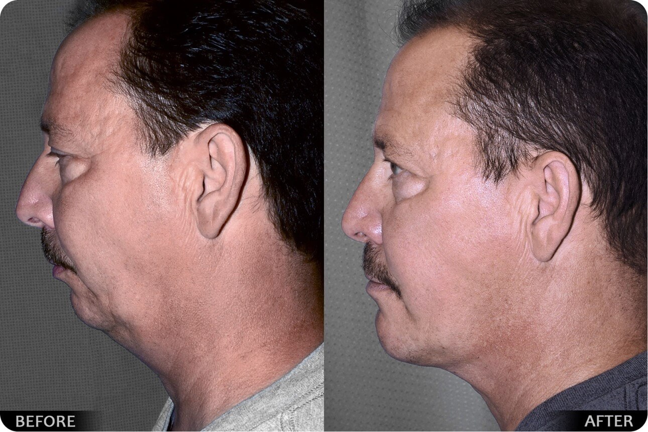 Face lift before and after - 02