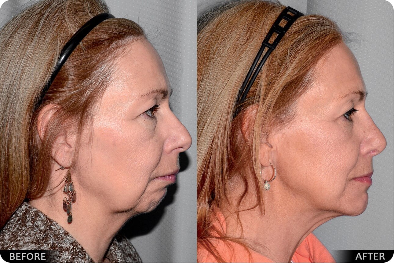 Face lift before and after - 05