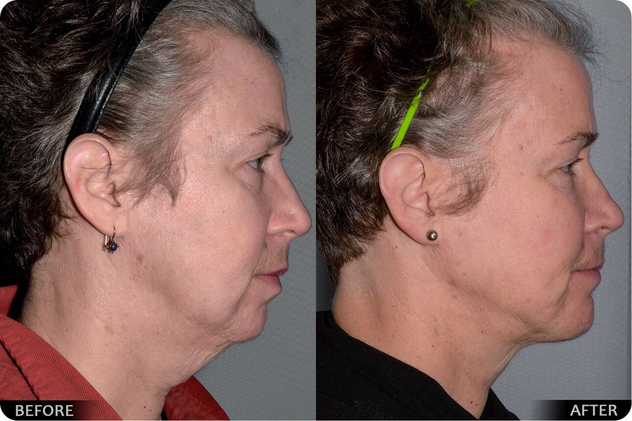 Face lift before and after - 06