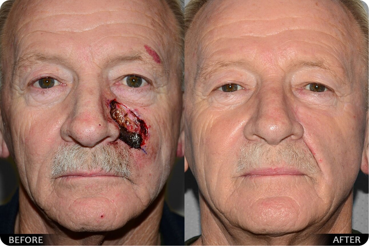 Nasal and Facial Reconstruction before after 012