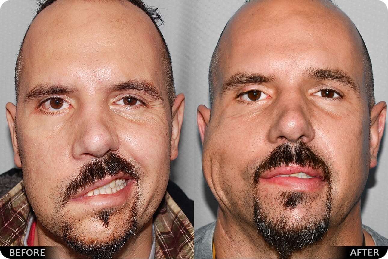 Nasal and Facial Reconstruction before after 04
