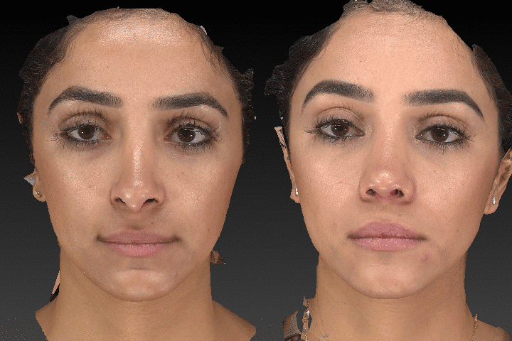 Rhinoplasty before after result case 03
