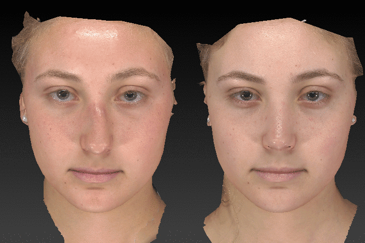 Rhinoplasty before after result case 04