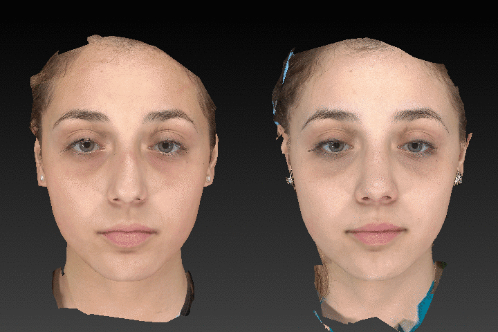 Rhinoplasty before after result case 06