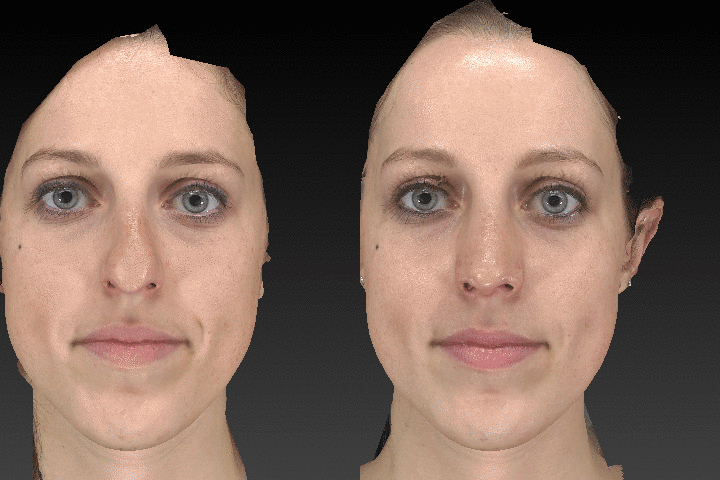 Rhinoplasty before after result case 07