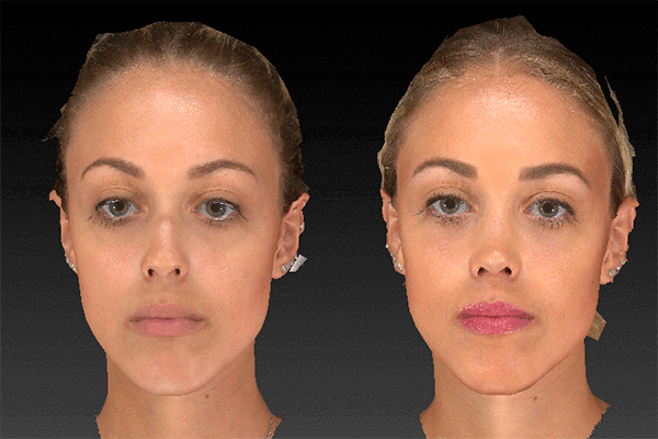 Rhinoplasty before after result case 05