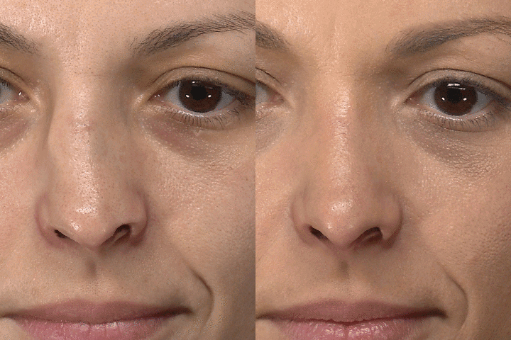Rhinoplasty before after result case 09