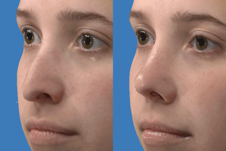 Rhinoplasty before after result case 02