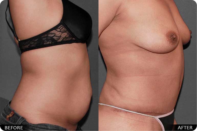 Tummy before after case 01
