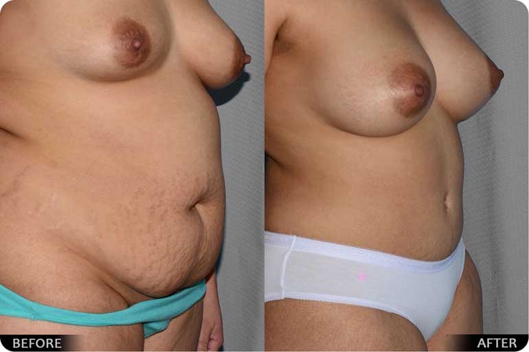Tummy before after case 03