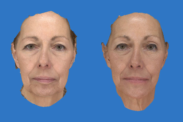 Face lift before and after results - 01
