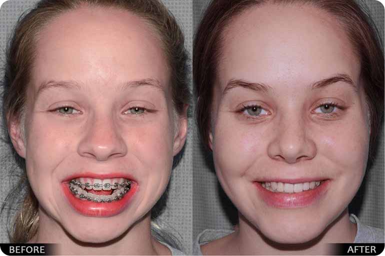 Orthognathic before and after Image 03