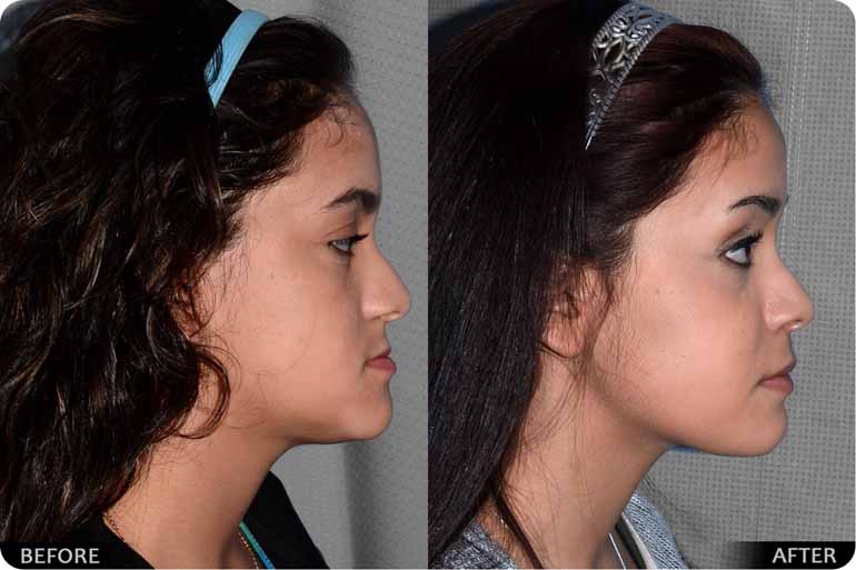 Orthognathic before and after Image 05