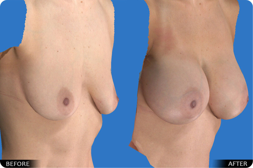 Breast Lift / Augmentation - Case 08