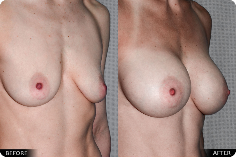 Breast Lift / Augmentation - Case 24