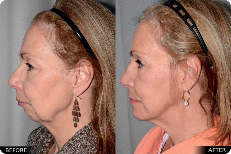 Cosmetic Facelift – Case 54